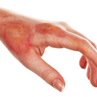 Horrible burn injury on female hand Horrible burn injury on female hand
