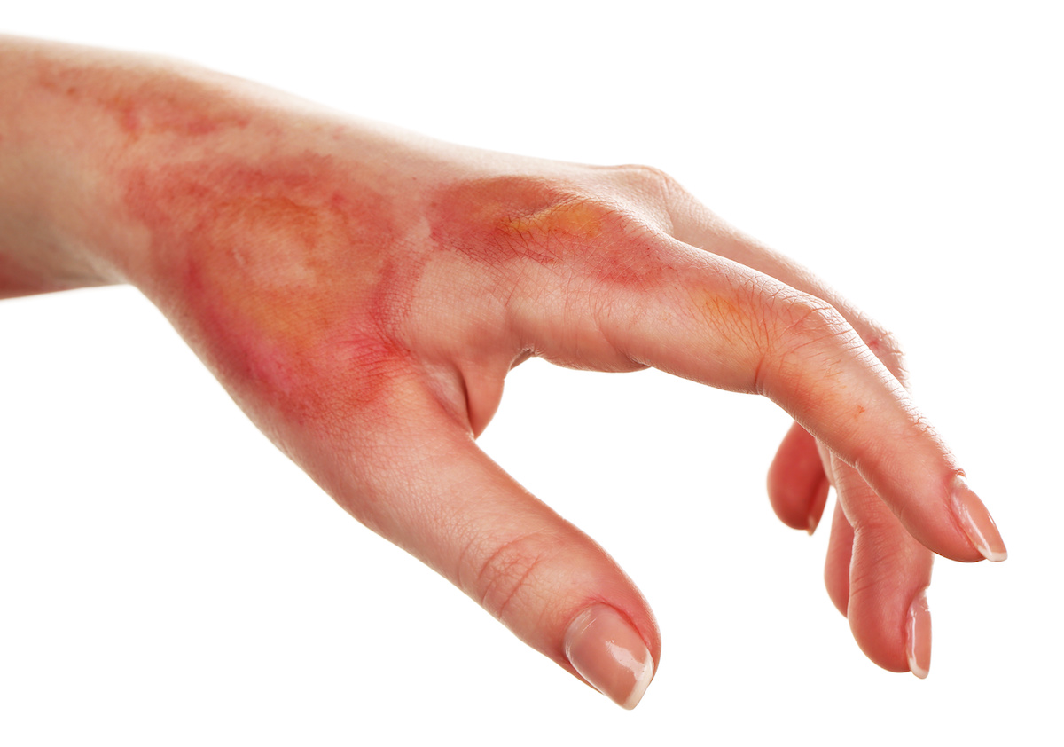 What You Need to Know about Burn Injuries Gilbert Adams Law Offices