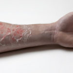 Burnt arm Burnt arm