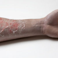 Burnt arm Burnt arm