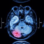 Close up of MRI brain : Lower part of brain ( eyes , temporal lo