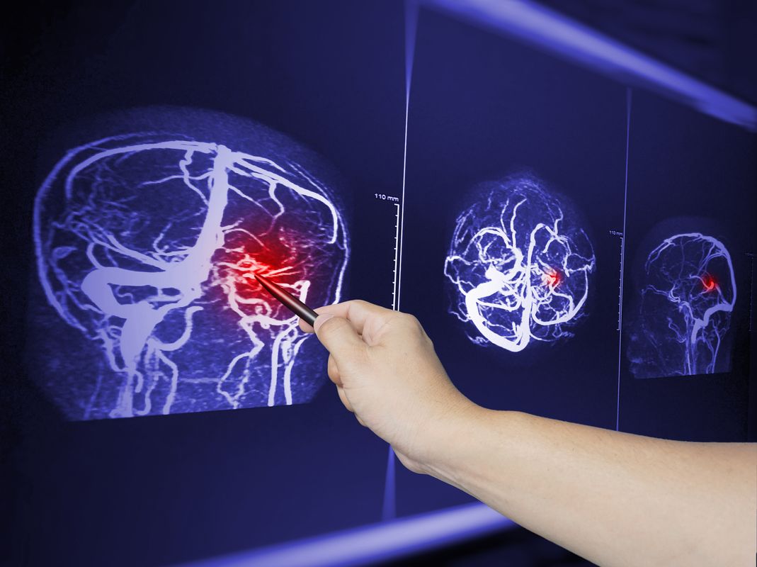 How To Prove Traumatic Brain Injury (TBI) In A TX Personal Injury Case